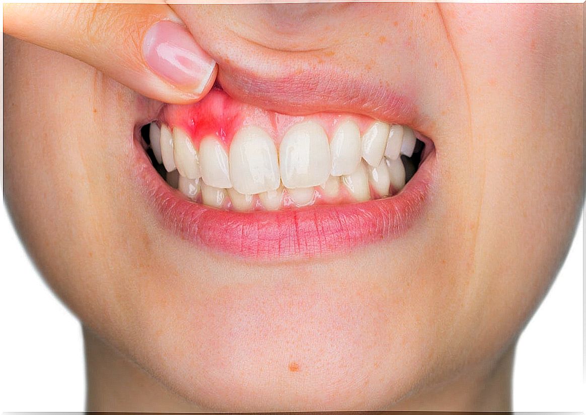 Gingivitis with enlargement of the gums.