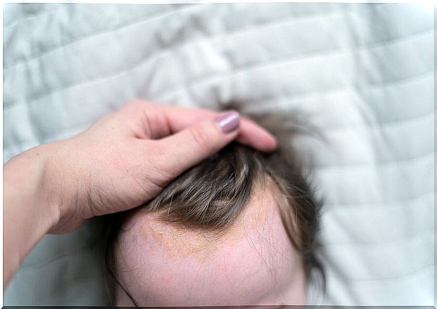 Baby with cradle cap