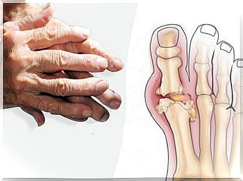 Arthritis: types, treatments and recommendations