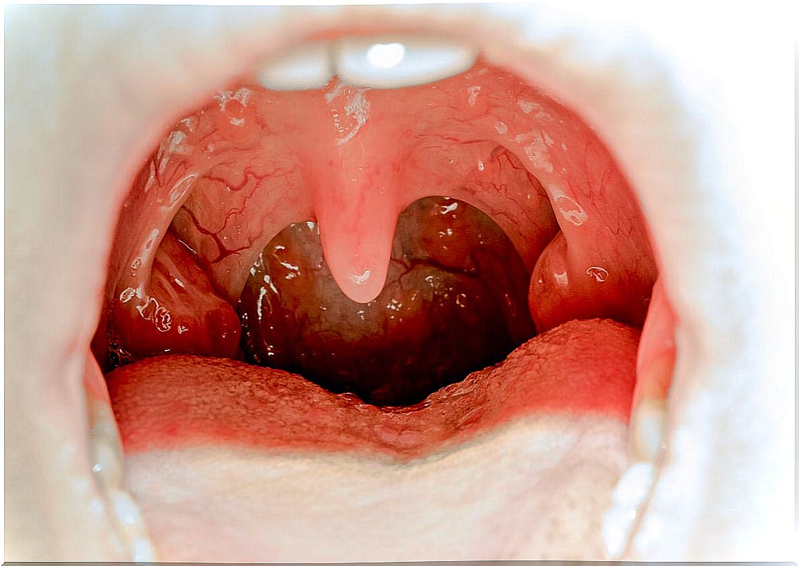 Throat with tonsillitis