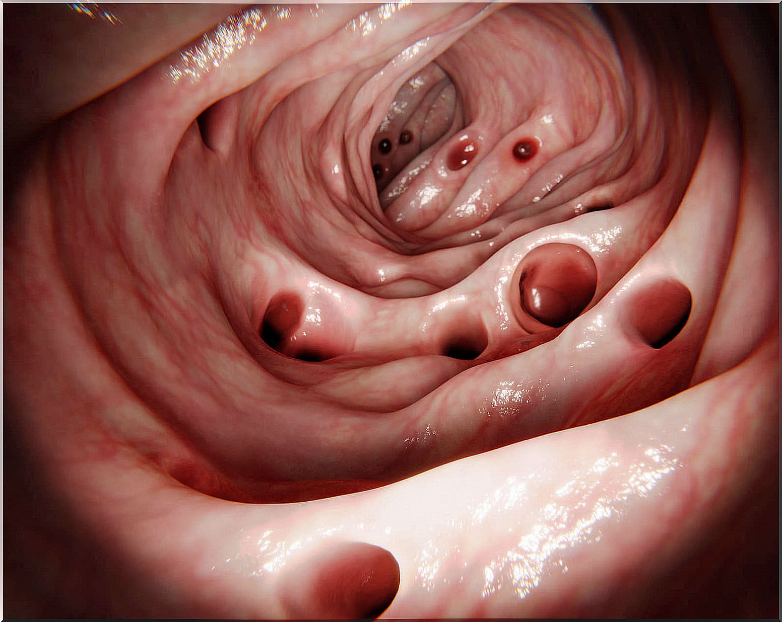 Diverticula in the large intestine.