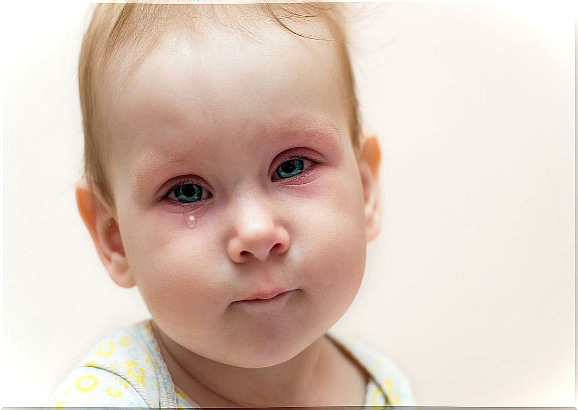 Conjunctivitis in a child with an obstructed tear duct.