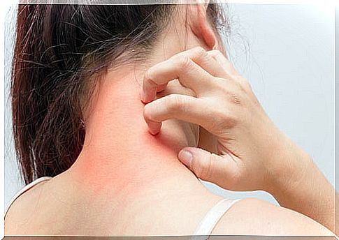 How to naturally cure itchy eczema