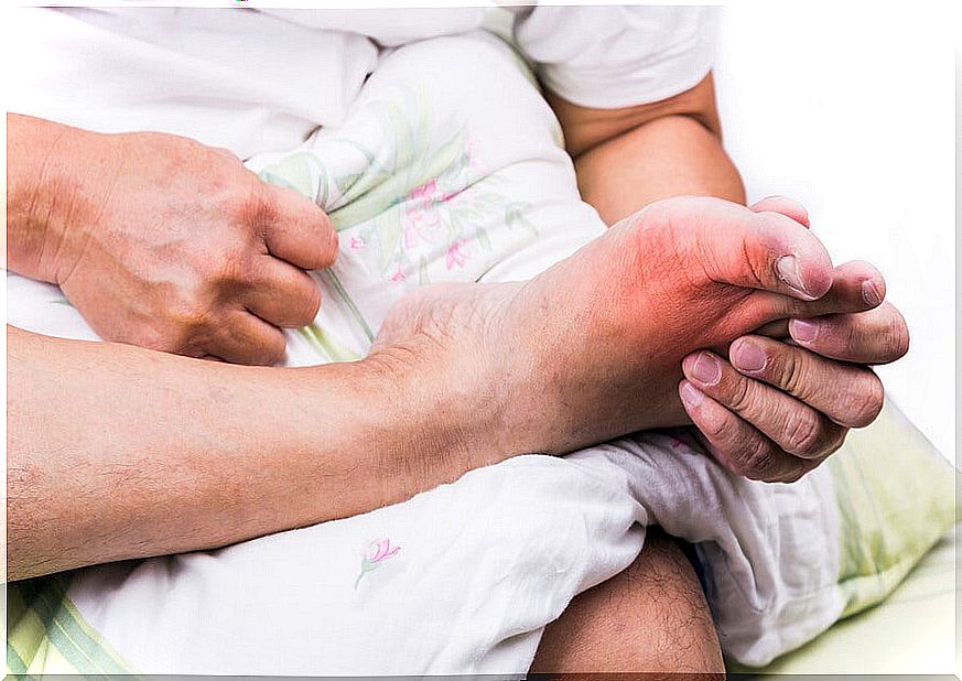 A person with foot pain from high uric acid