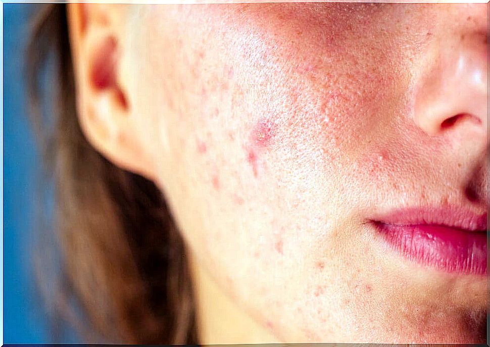 Acne is one of the main skin diseases