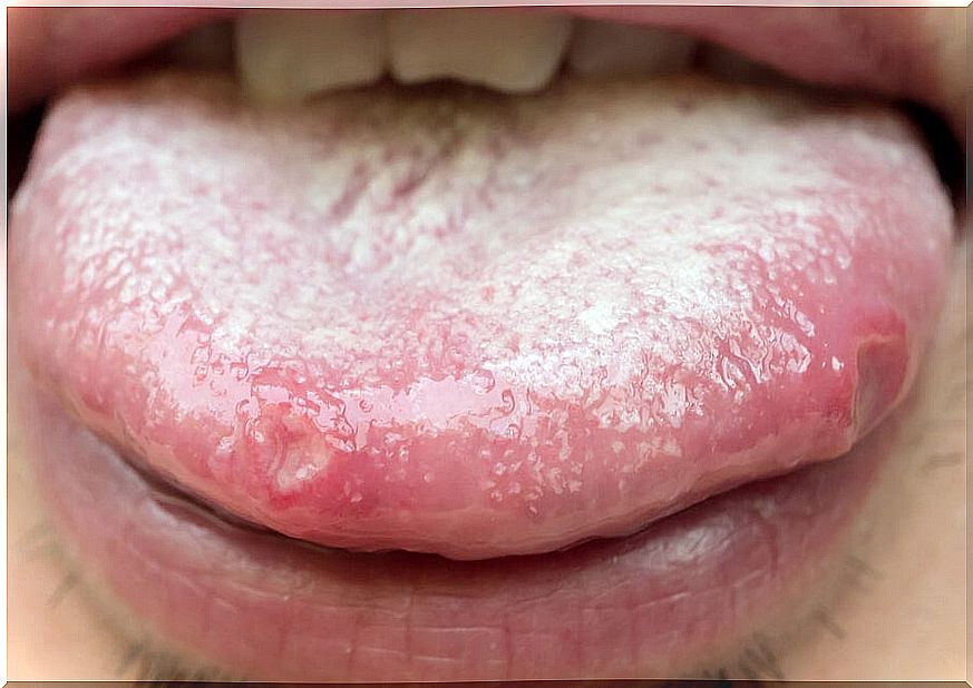 Tongue with white spots typical of oral candidiasis