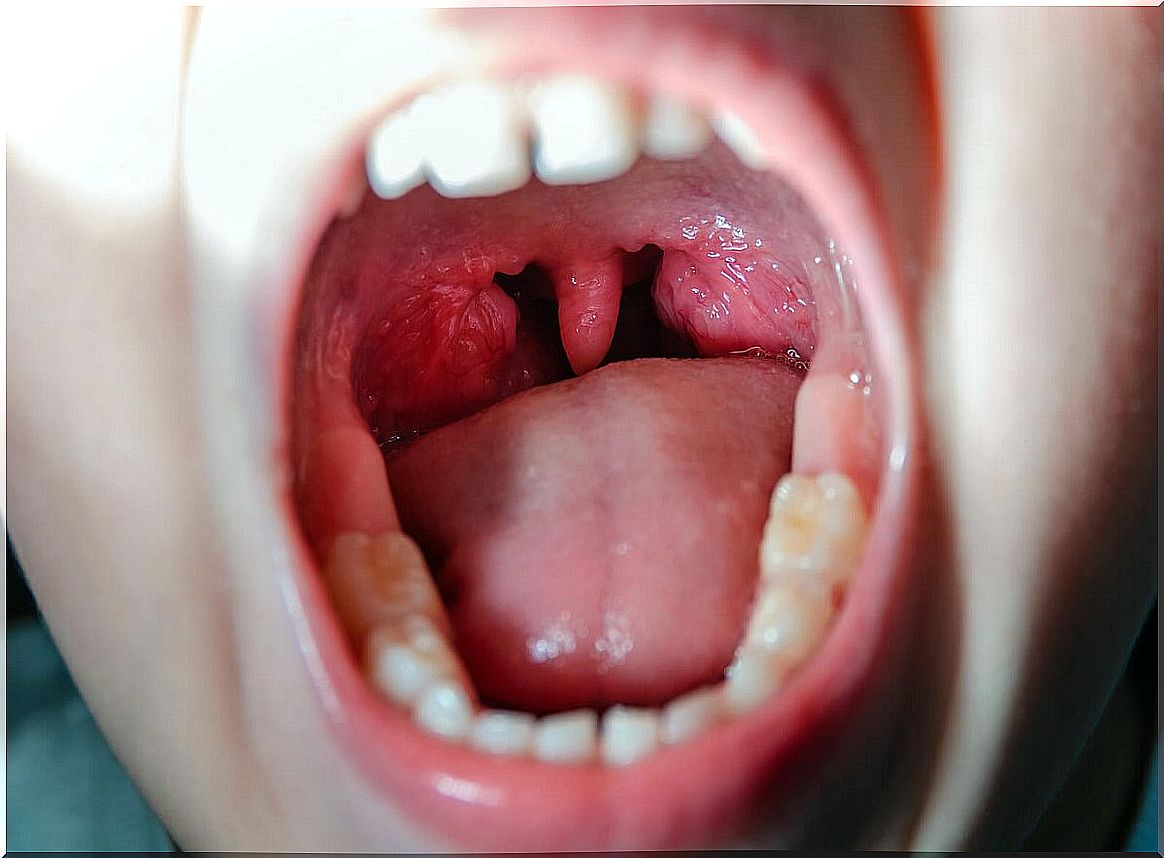 Medical treatments for tonsillitis in children