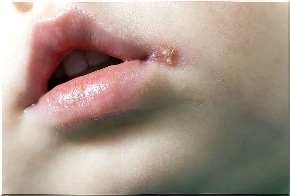 Cold sores in children