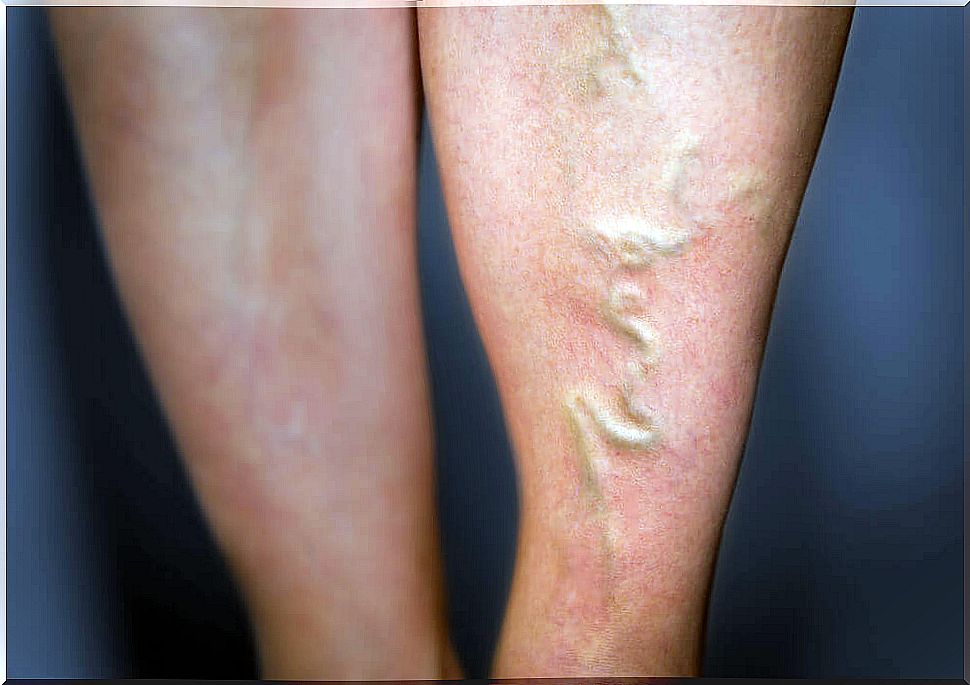 varicose veins